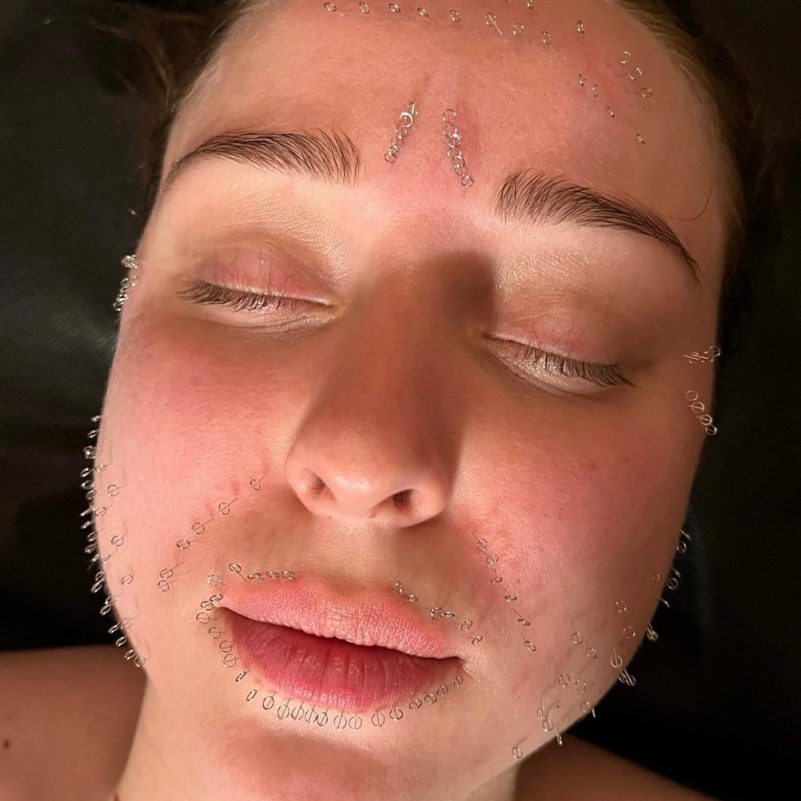 Pinezkowanie Estetyczne